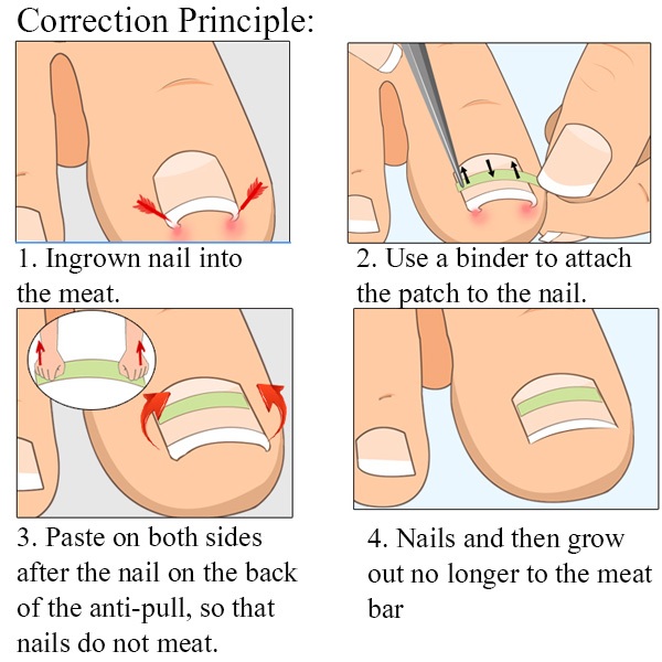 Ingrown-Toenail-Straightening-Clip-Curved-BS-Brace-Toenails-Thick-Paronychia-Correction-Tool-About-1-1185545